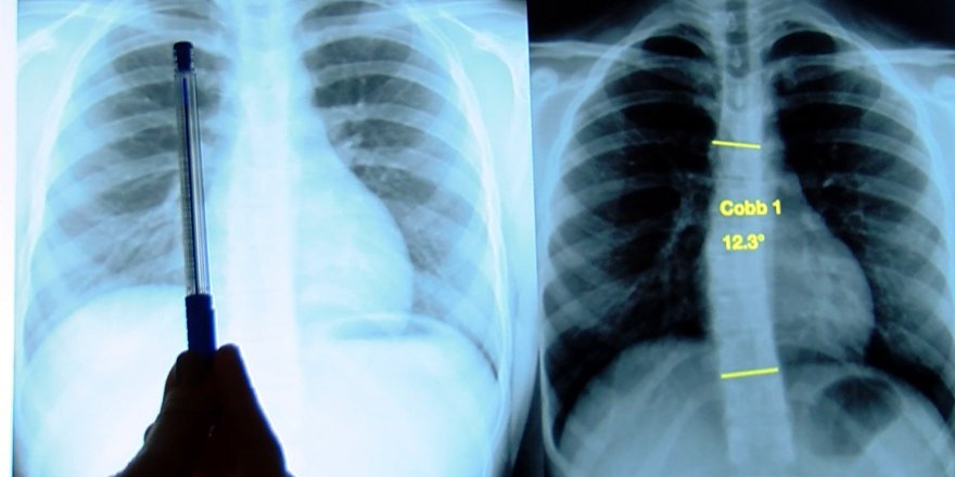 ERGENLİĞİN KÖTÜ SÜRPRİZİ SKOLYOZDA EZBER BOZAN ARAŞTIRMA