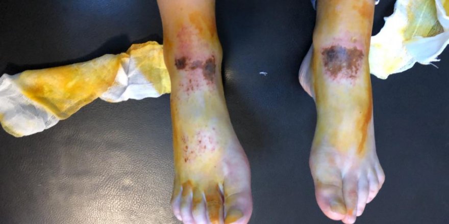 'GİZEMLİ YANIKLAR' BUZ YARALANMASI ÇIKTI