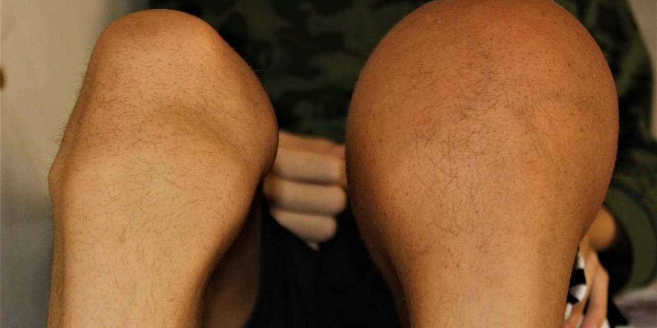 Kemik Kanseri Olan Mustafa Yardım Bekliyor