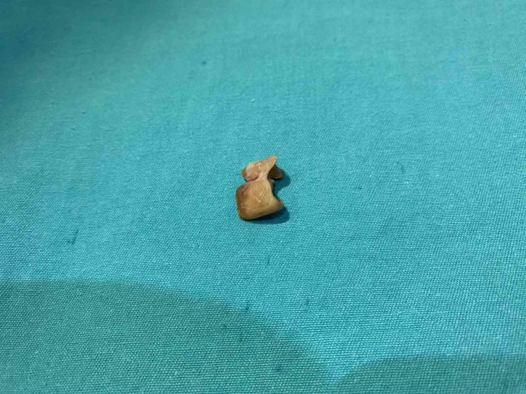 UYKUSUNDA YUTTUĞU DİŞLER BRONŞUNDAN ÇIKARILDI