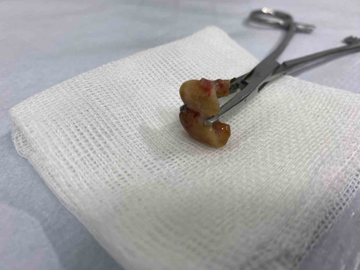 UYKUSUNDA YUTTUĞU DİŞLER BRONŞUNDAN ÇIKARILDI