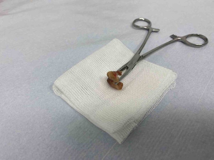 UYKUSUNDA YUTTUĞU DİŞLER BRONŞUNDAN ÇIKARILDI