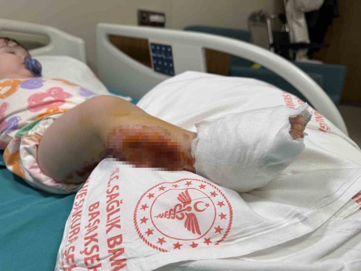 ÜZERİNE ÇAYDANLIK DEVRİLEN 1 YAŞINDAKİ BEBEK DEHŞETİ YAŞADI, VÜCUDUNUN YÜZDE 15’İ YANDI